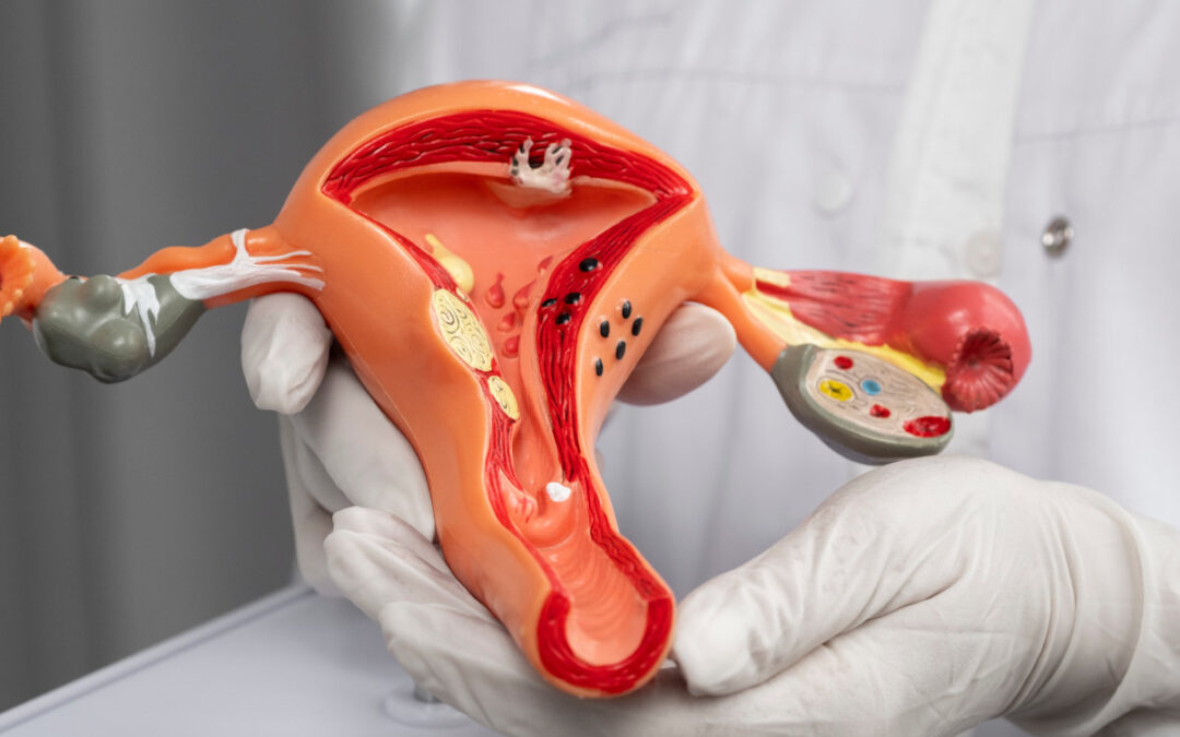 L’endometriosi: che cos’è e perchè è così difficile individuare la cura?