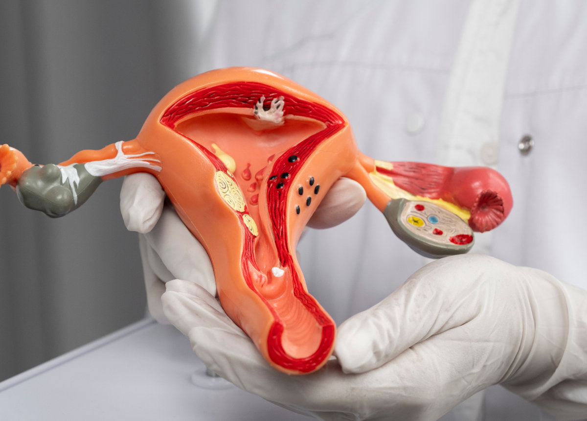 endometriosi-cosa-è-difficile-trovare-cura