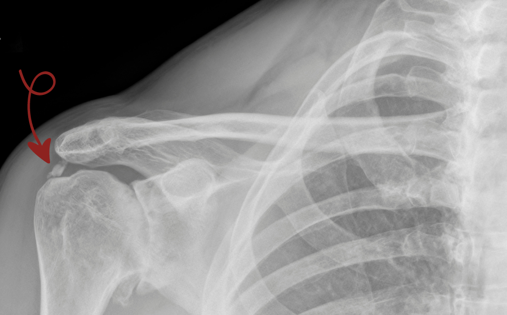 Calcificazione di Spalla: Sintomi, Cause e Trattamento