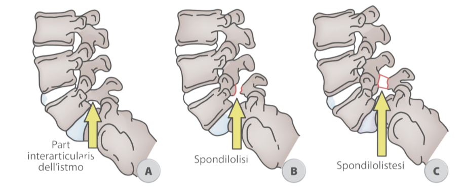 Spondilolisi e Spondilolistesi