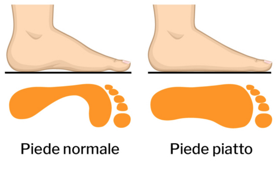 Piede piatto. Cause, sintomi e come intervenire.