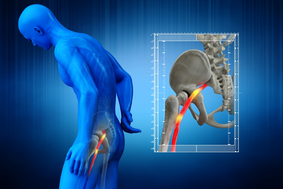 La sindrome del piriforme