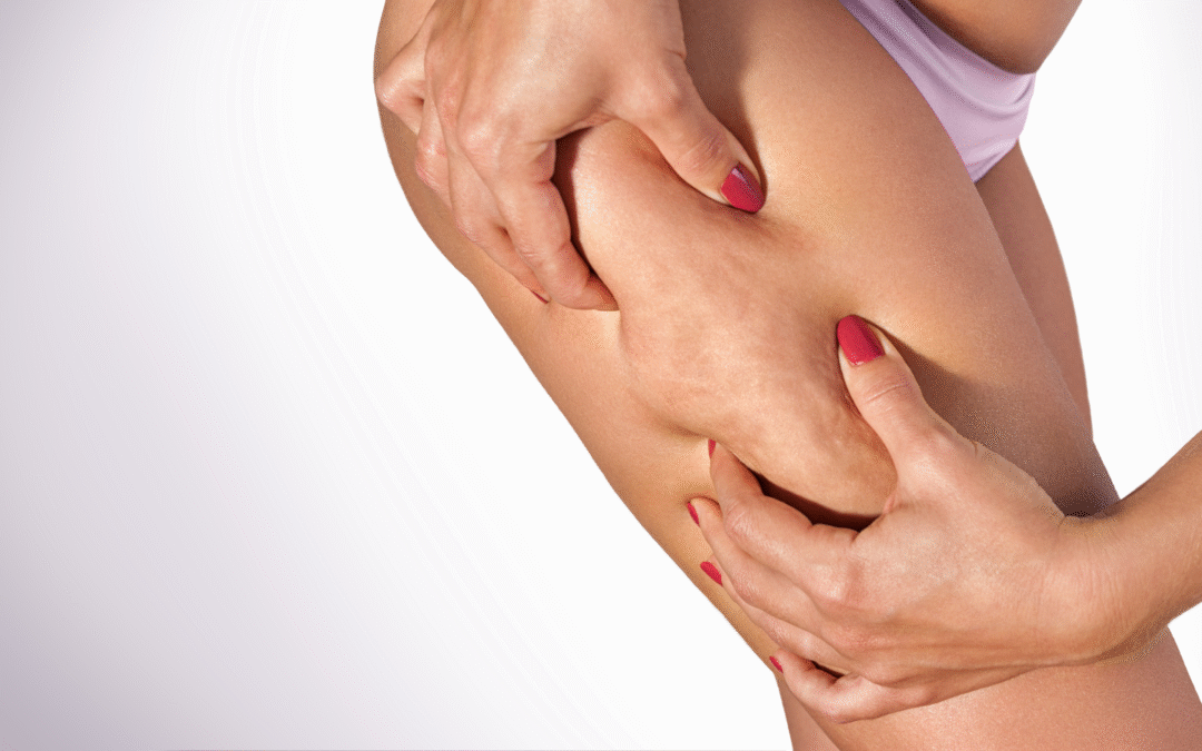Lipedema: la malattia invisibile delle cellule adipose che colpisce (quasi) solo le donne