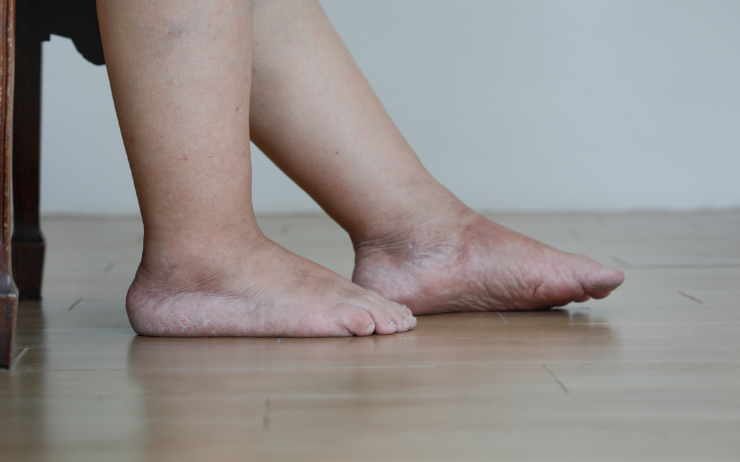 Linfedema e lipedema: differenze, sintomi e trattamento