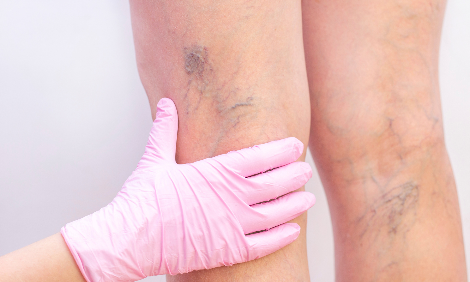 VALUTAZIONE-VARICI-LINFEDEMA