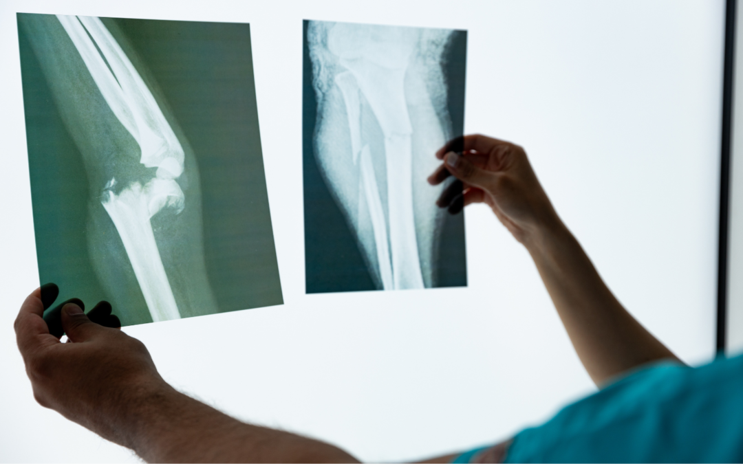 Osteoporosi: quali esercizi aiutano davvero? Guida al movimento corretto